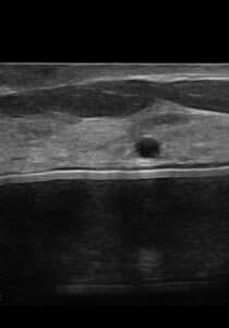 Ultrasound Sub Musclular versus Sub Glandular