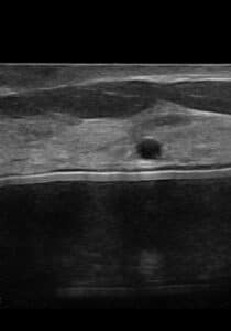 Ultrasound Sub Musclular versus Sub Glandular