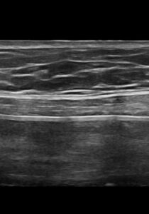 Ultrasound Sub Musclular versus Sub Glandular