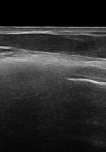 Ultrasound Ruptured Silicone Implant