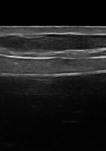 Ultrasound Ruptured Silicone Implant