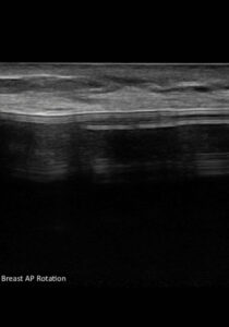 Ultrasound Allergan sub muscular junction versus Sientra flipped orientation