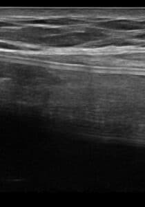 Ultrasound Allergan sub muscular junction versus Sientra flipped orientation