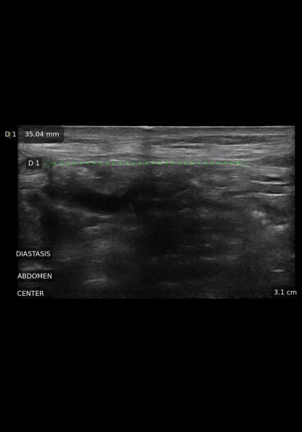 After Image: Ultrasound Abdominal Wall - front