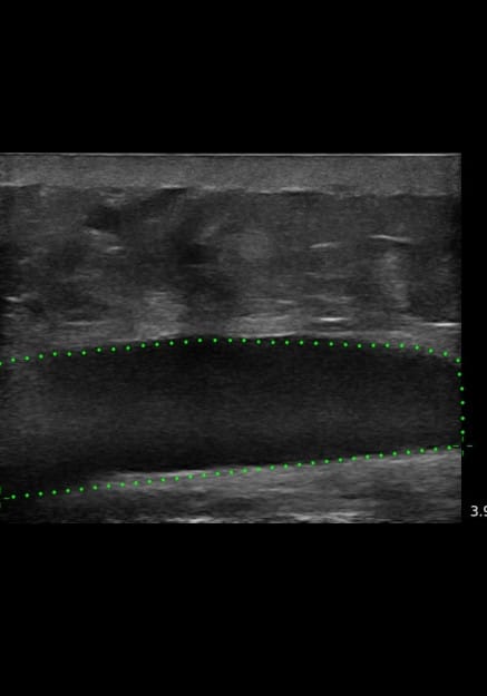 Before Image: Ultrasound Abdominal Wall - front