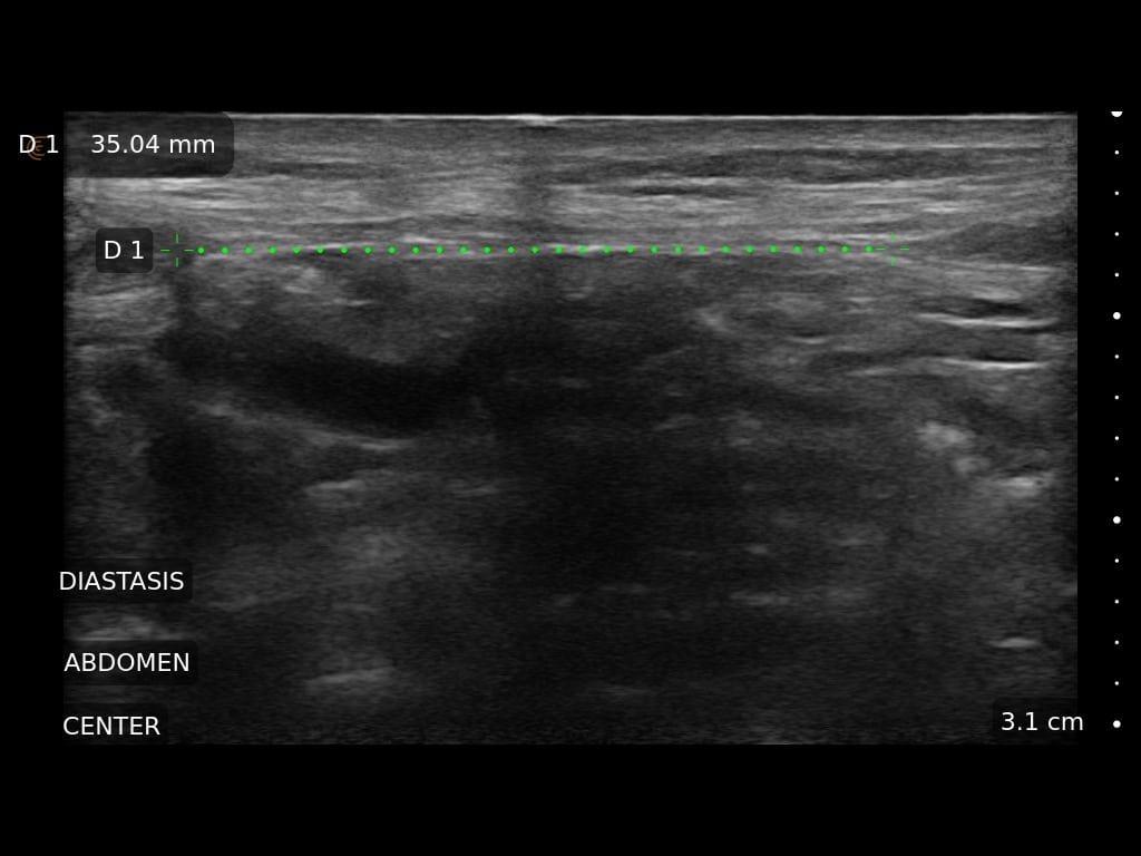 Ultrasound can measure diastasis, the distance between rectus muscles. This is repaired during abdominoplasty.