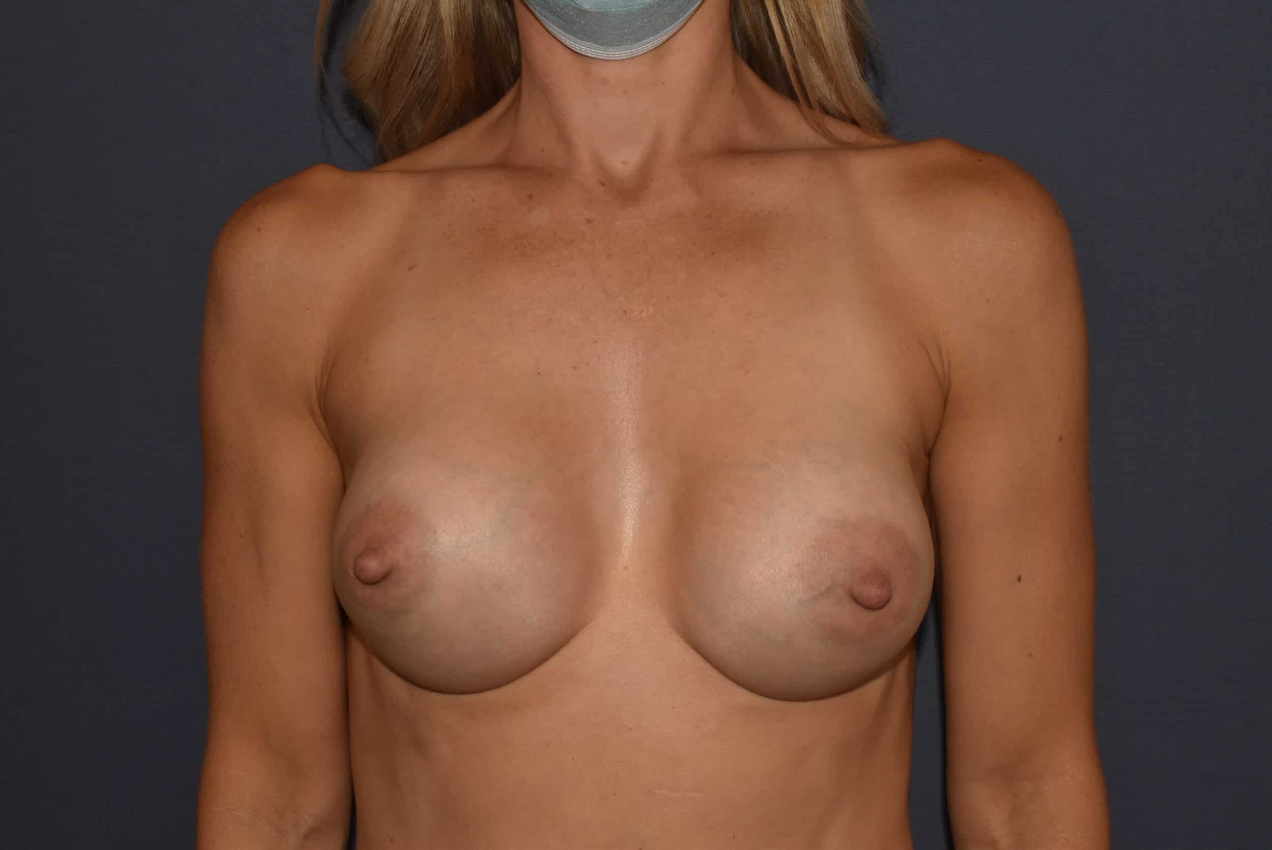 After Image: Mommy Makeover 9 – Breast Augmentation - front