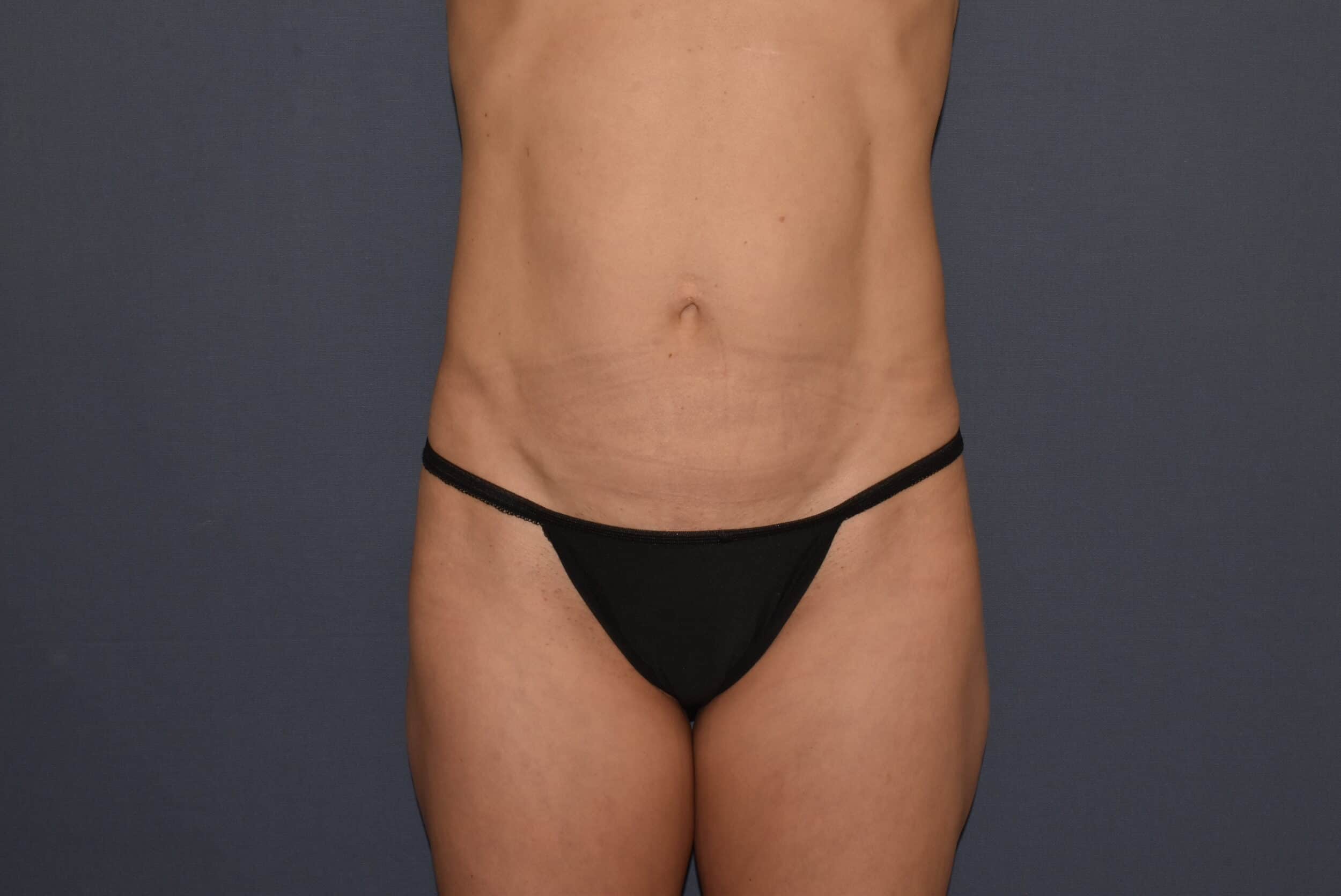 Before Image: Mommy Makeover 9 – Mini Abdominoplasty - front