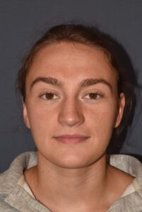 Rhinoplasty – Open with Functional Airway