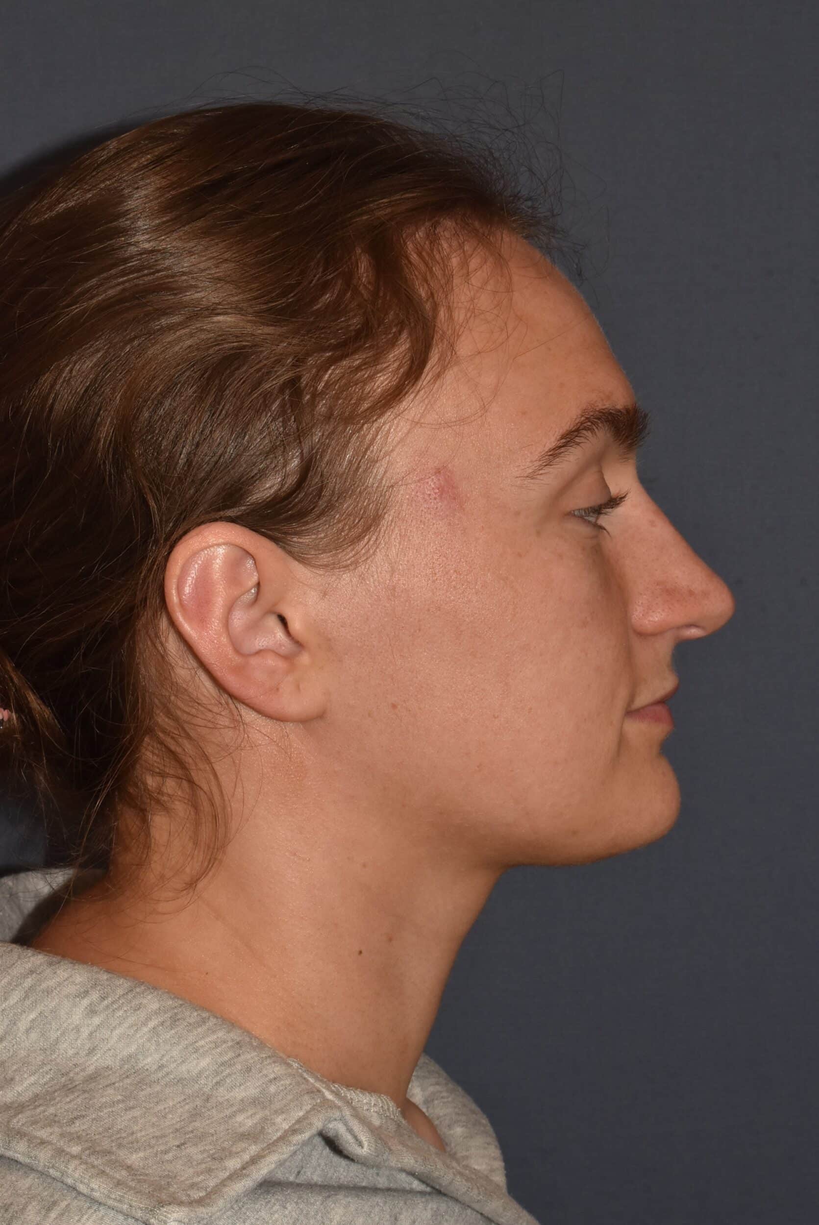 After Image: Rhinoplasty – Open with Functional Airway - right-side