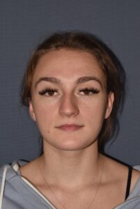 Rhinoplasty – Open with Functional Airway