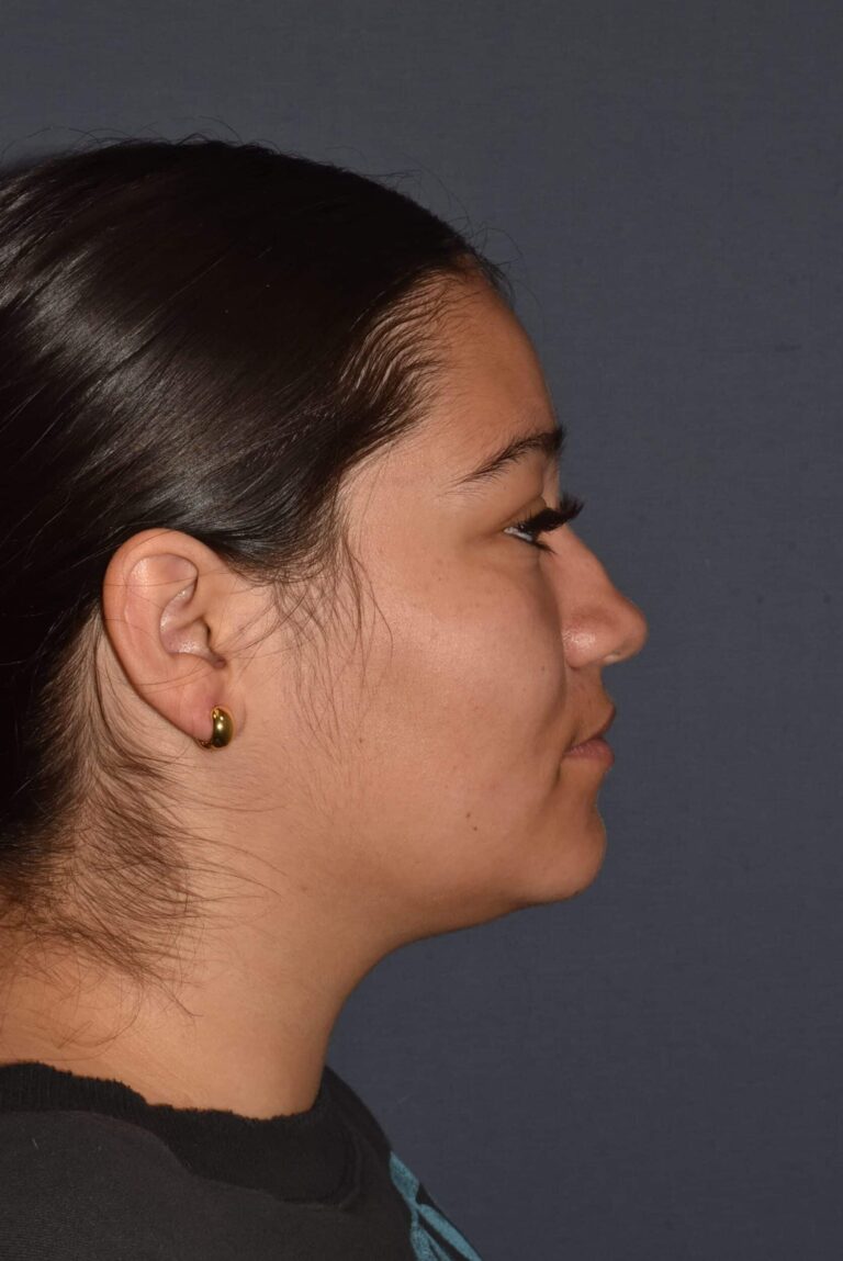 Before Image: Rhinoplasty – Closed - right-side