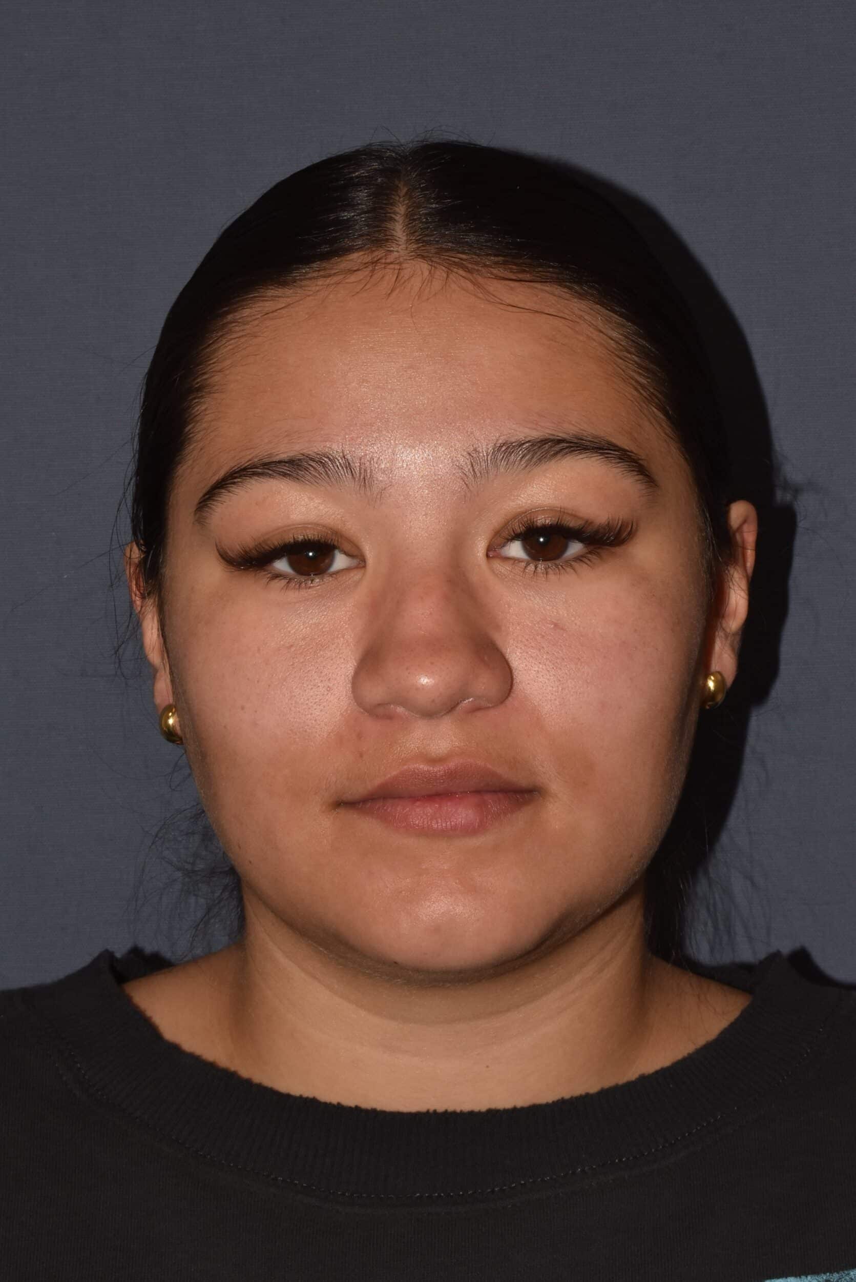 Before Image: Rhinoplasty – Closed - front