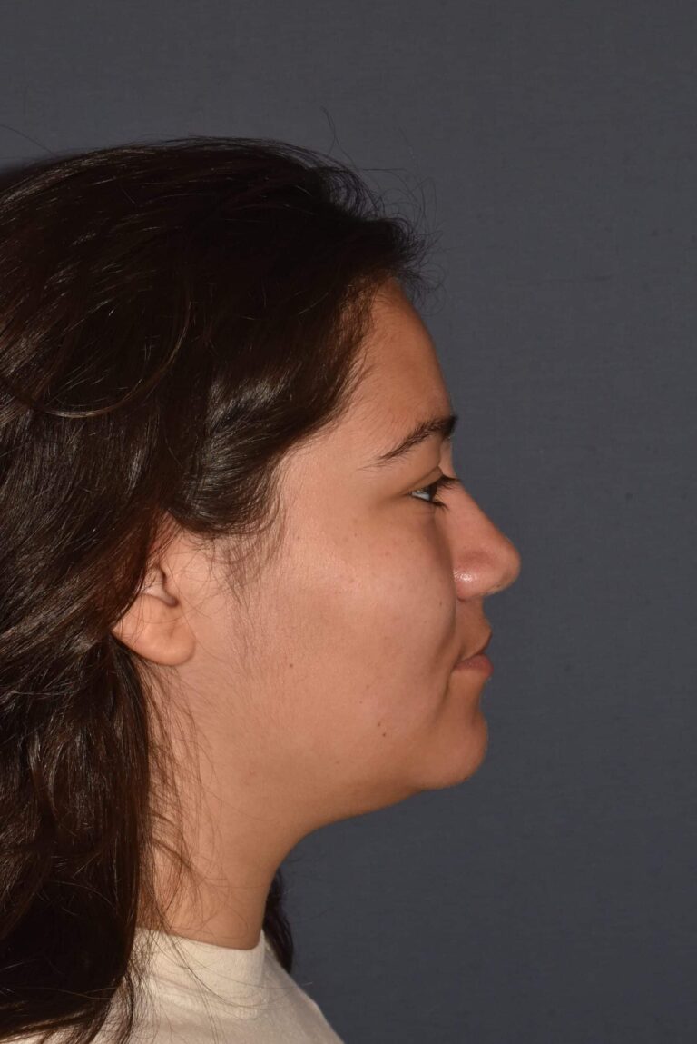 After Image: Rhinoplasty – Closed - right-side