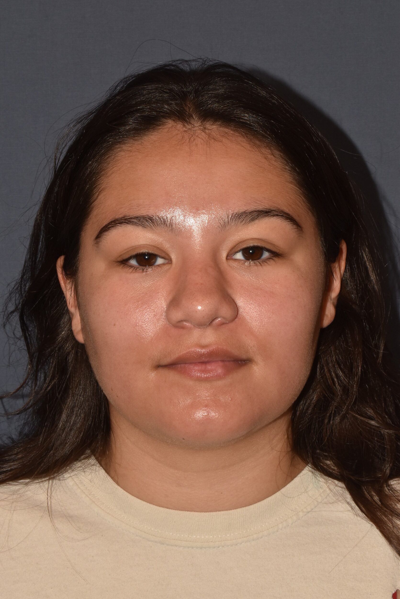 After Image: Rhinoplasty – Closed - front