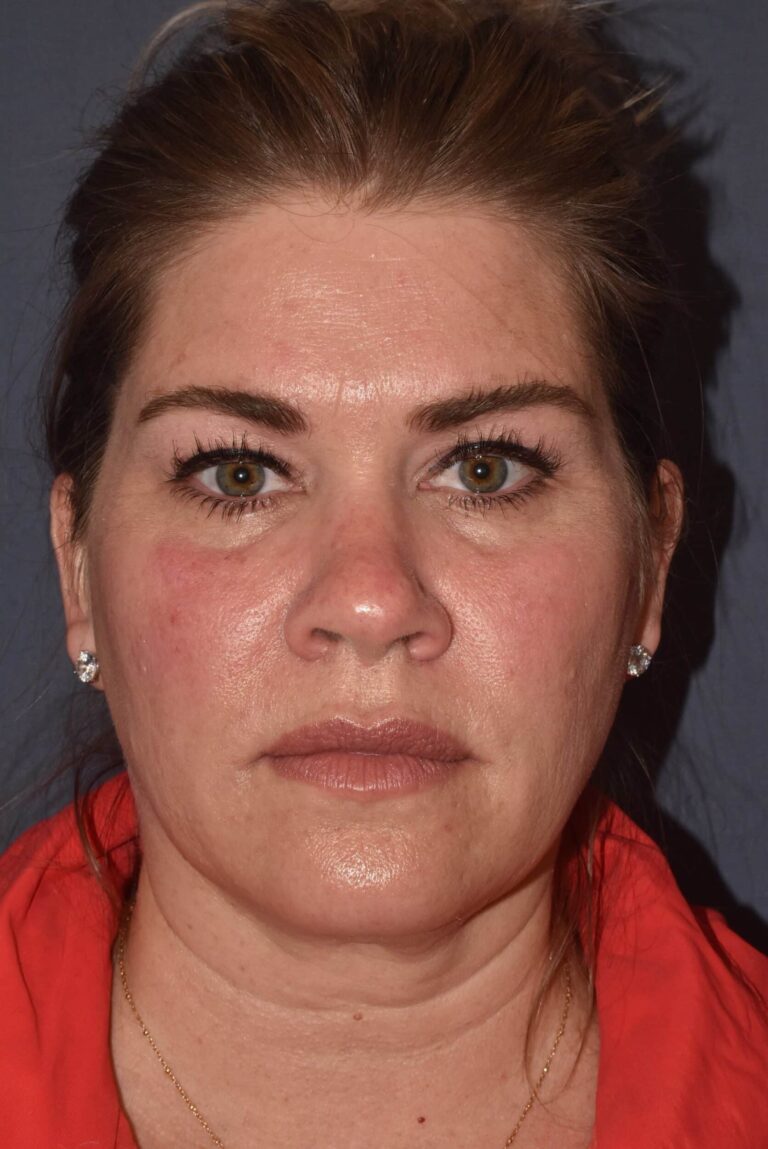 Before Image: Rhinoplasty – Open - front