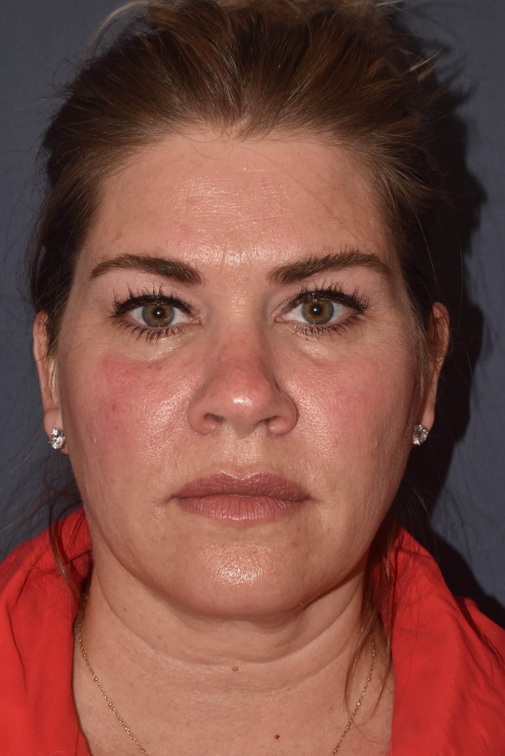 Before Image: Rhinoplasty – Open - front