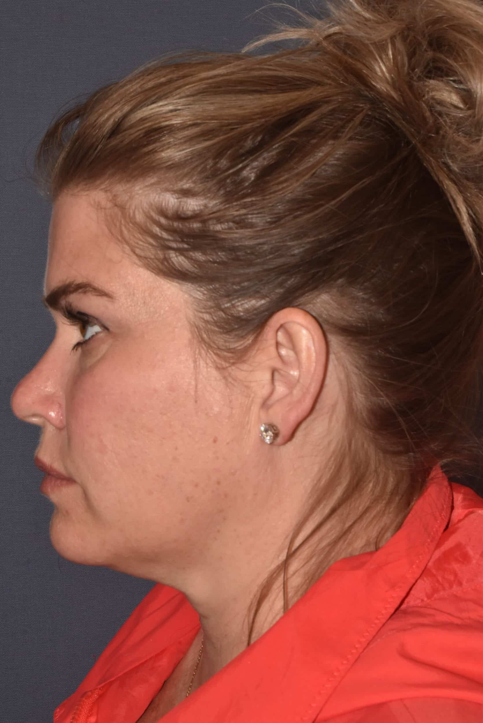 Before Image: Rhinoplasty – Open - left-side