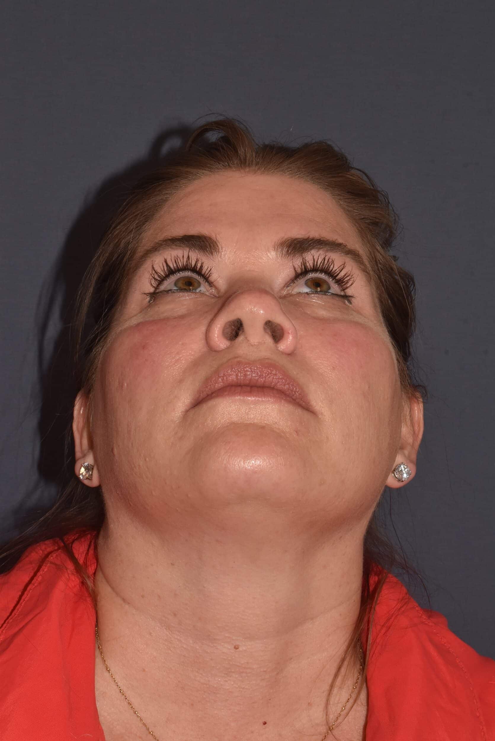 Before Image: Rhinoplasty – Open - 