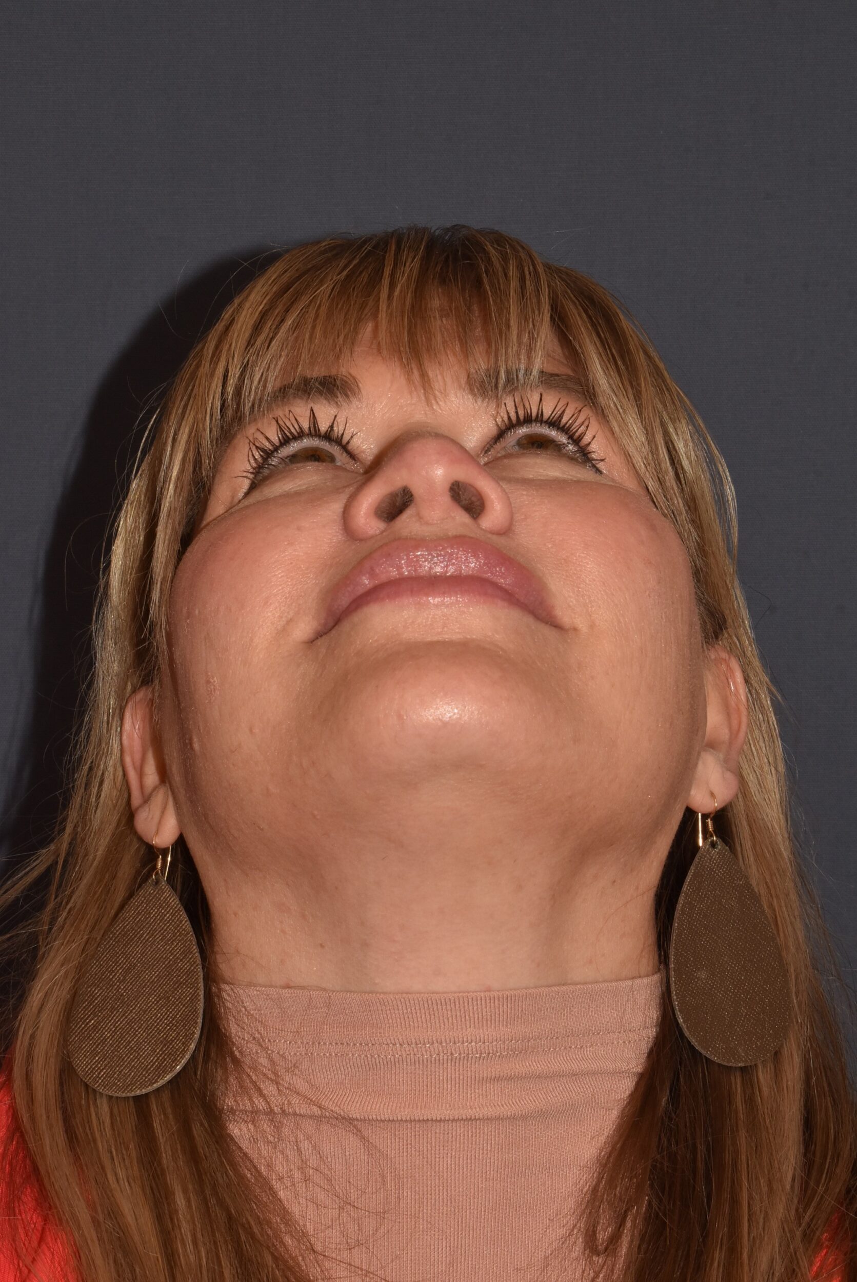 After Image: Rhinoplasty – Open - 
