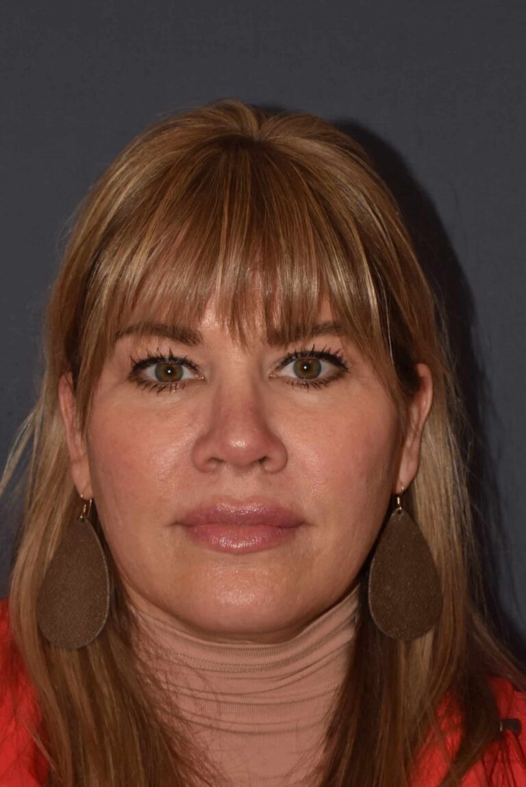 After Image: Rhinoplasty – Open - front