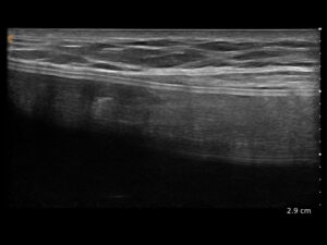 Smooth silicone implant at the pectoralis muscle / sub mammary junction without evidence of leakage.