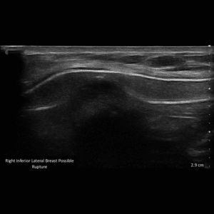 Intra Capusular ruptured silicone implant.