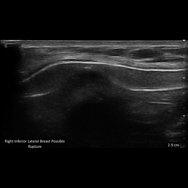 Intra Capusular ruptured silicone implant.