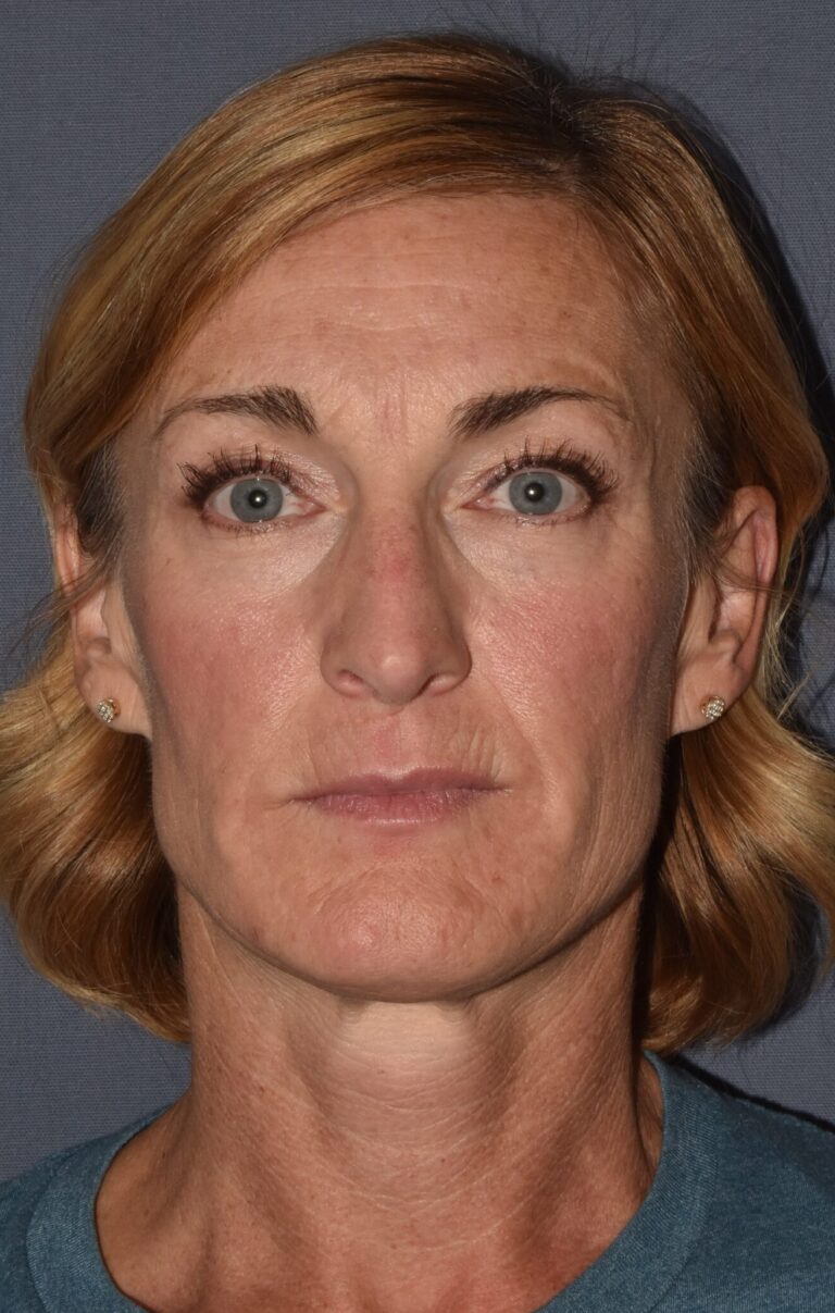 After Image: Rhinoplasty – Open - front