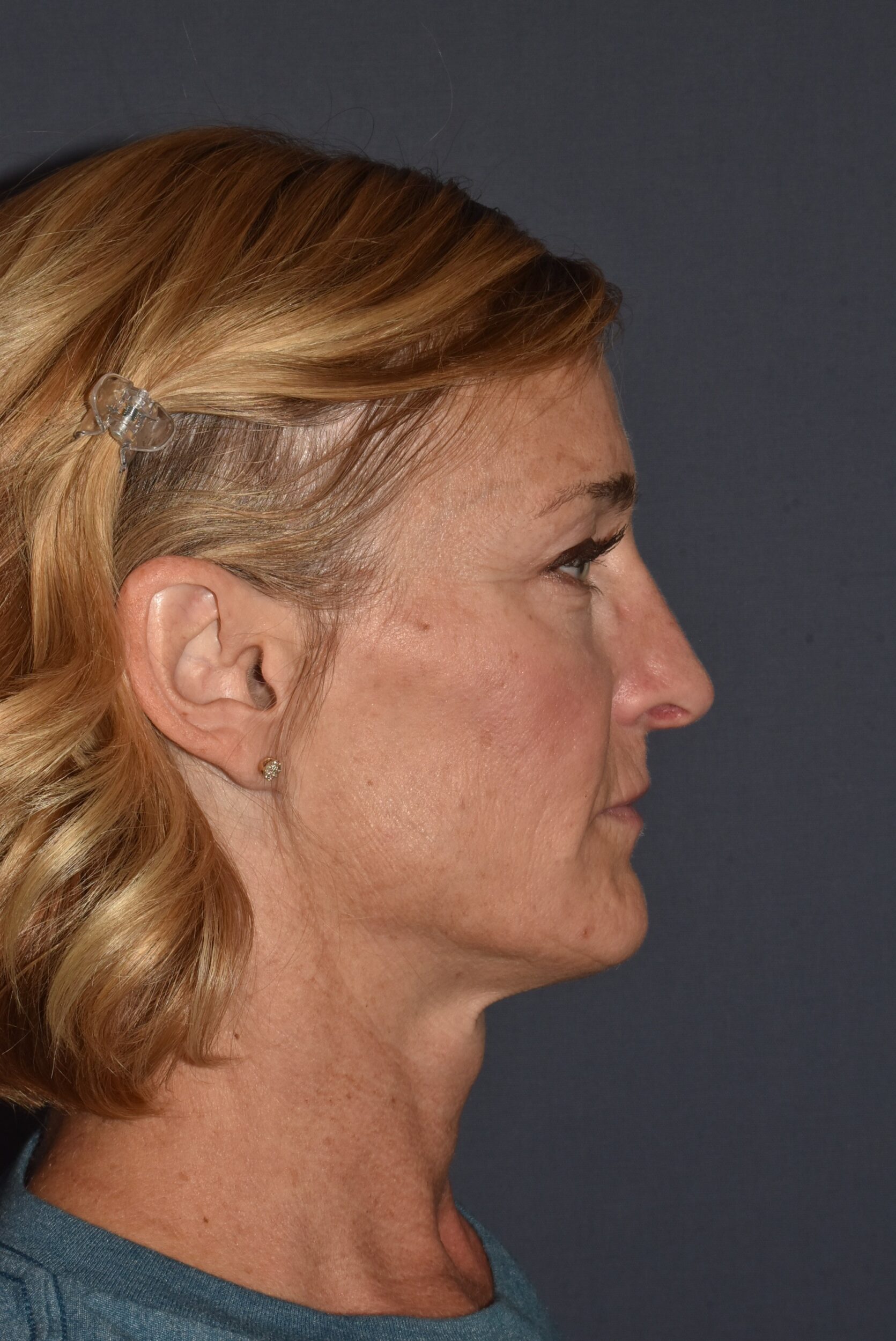 After Image: Rhinoplasty – Open - right-side