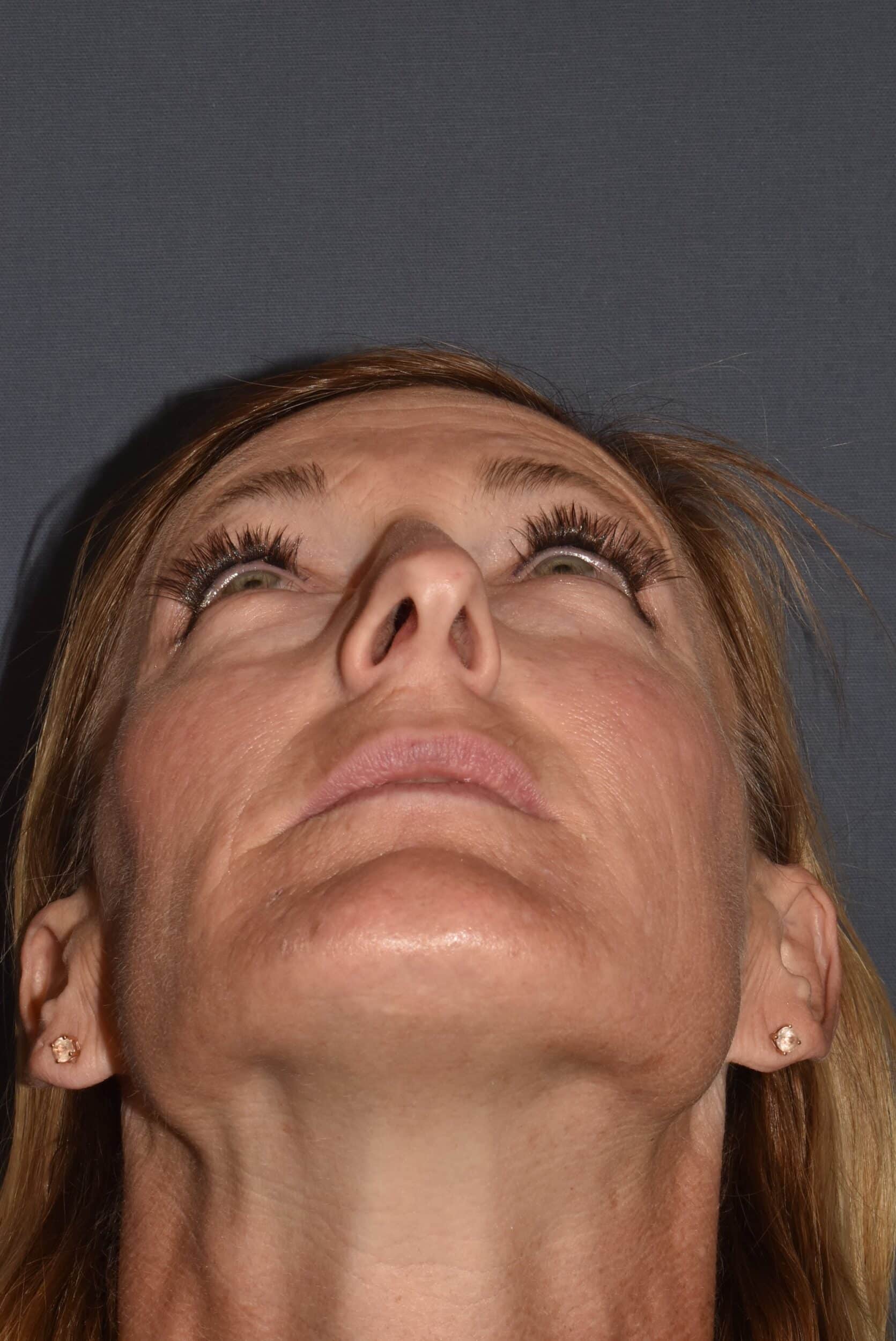 Before Image: Rhinoplasty – Open - 