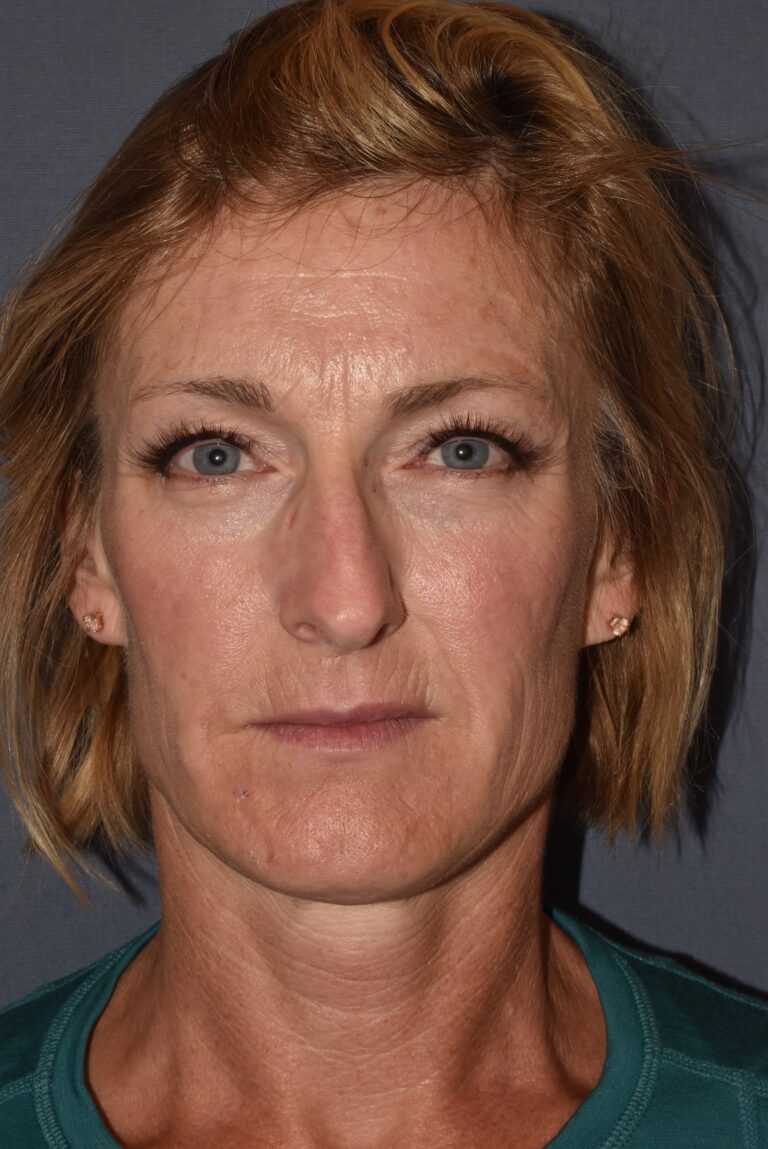 Before Image: Rhinoplasty – Open - front