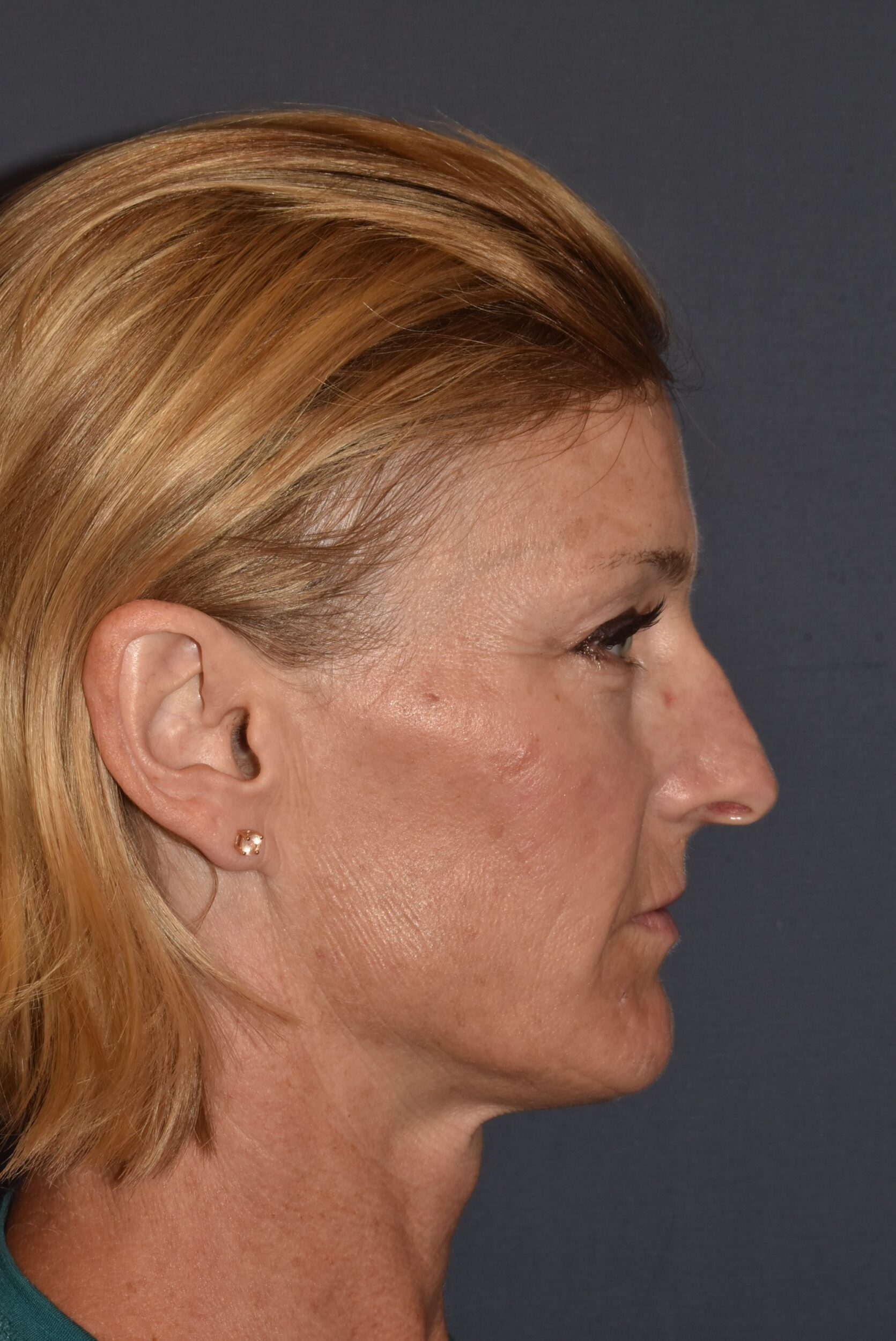 Before Image: Rhinoplasty – Open - right-side