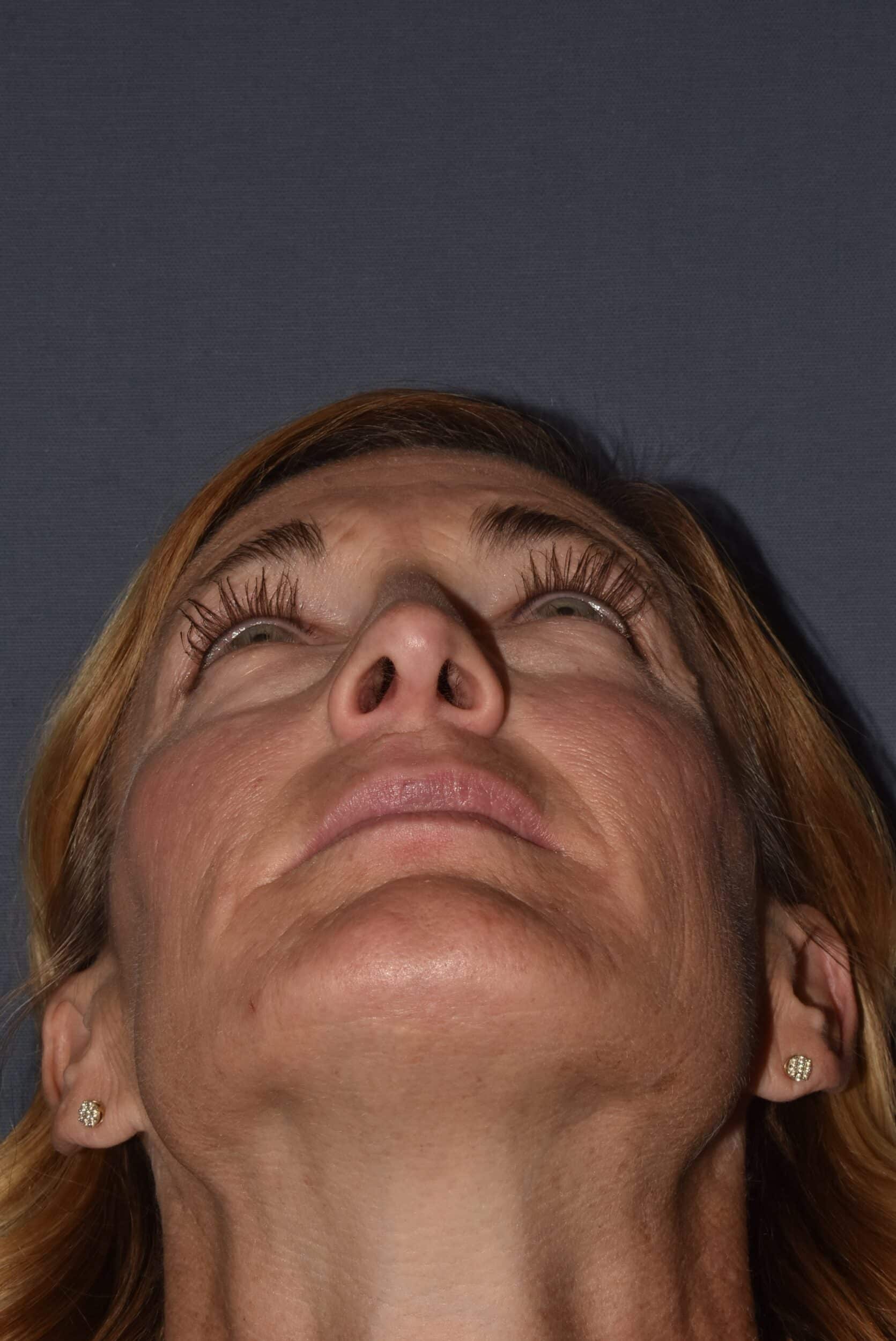 After Image: Rhinoplasty – Open - 