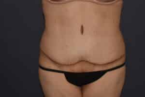 Massive Weight Loss – Abdominoplasty with Flank Liposuction
