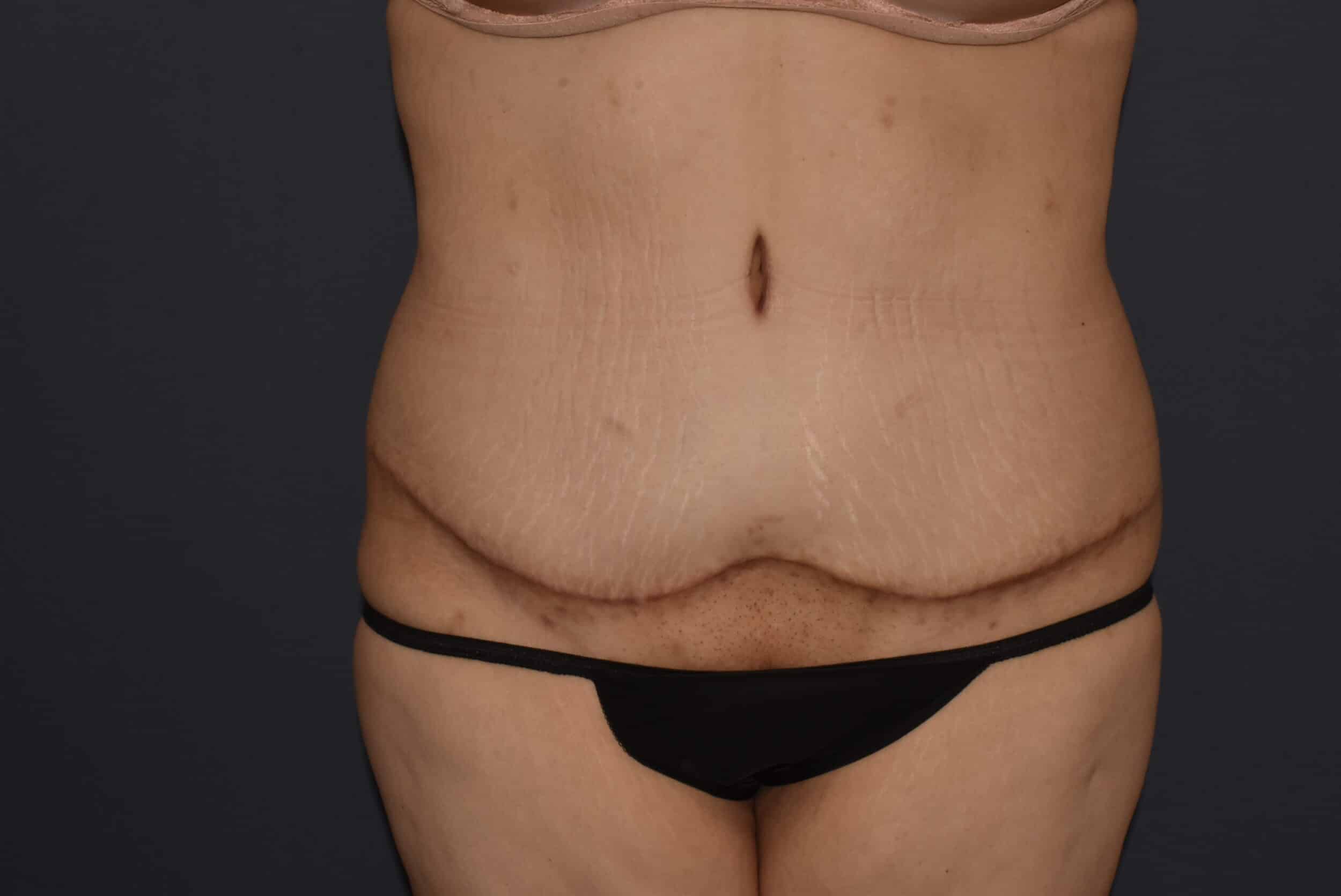 After Image: Massive Weight Loss – Abdominoplasty with Flank Liposuction - front