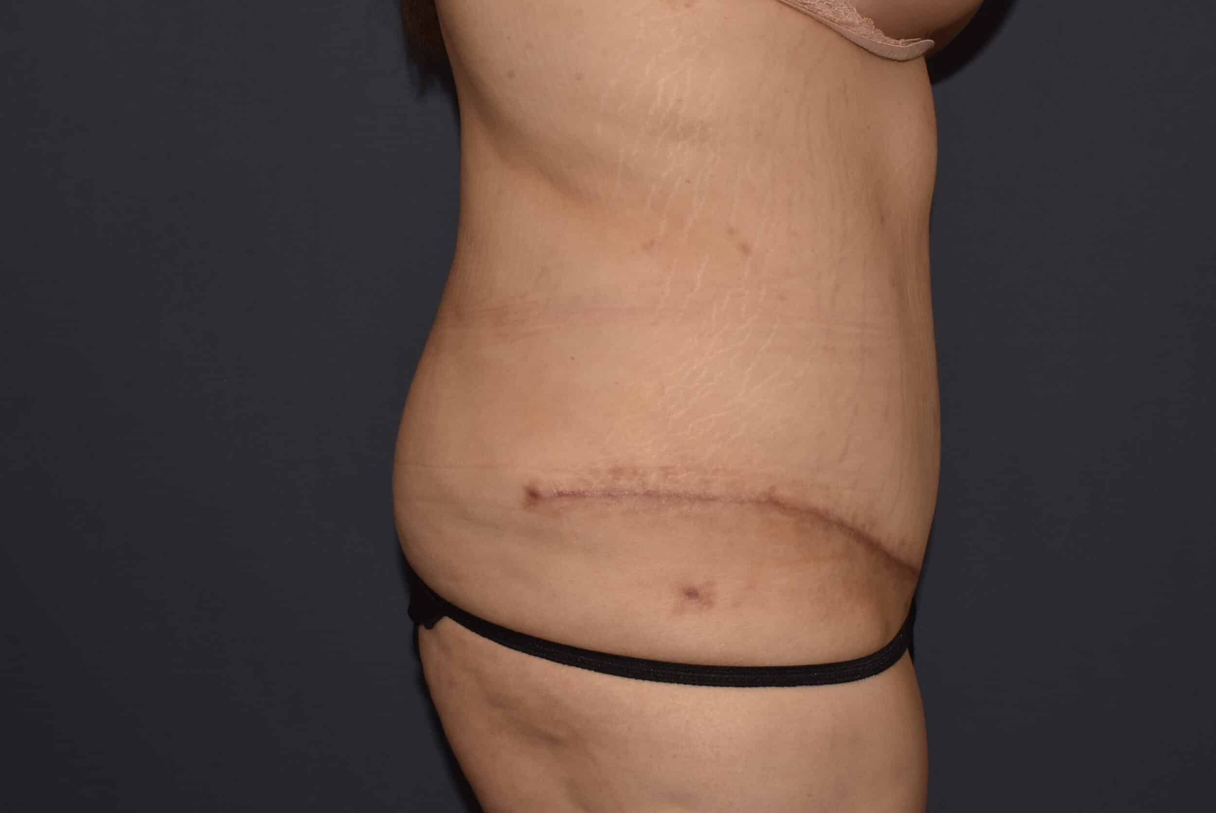 After Image: Massive Weight Loss – Abdominoplasty with Flank Liposuction - right-side