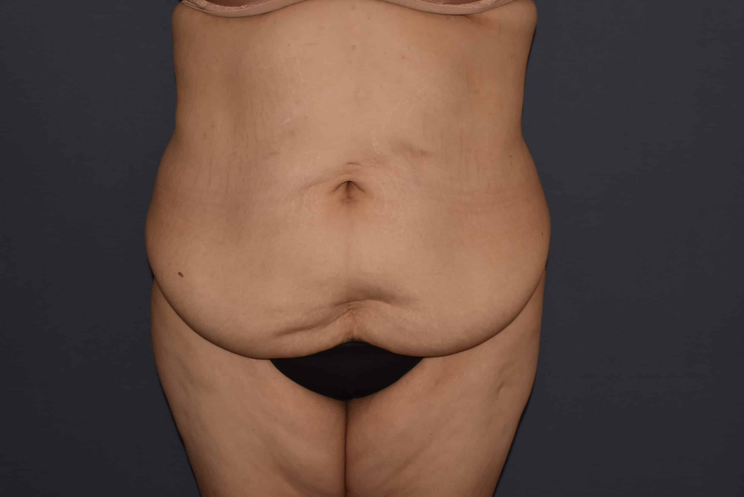 Before Image: Massive Weight Loss – Abdominoplasty with Flank Liposuction - front