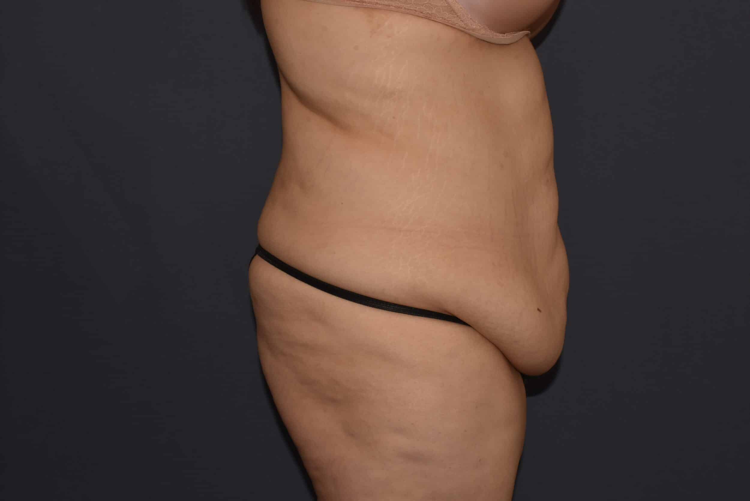 Before Image: Massive Weight Loss – Abdominoplasty with Flank Liposuction - right-side