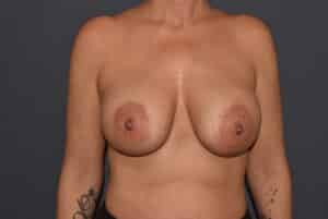 Breast Augmentation – Ptotic (Sagging) Breasts