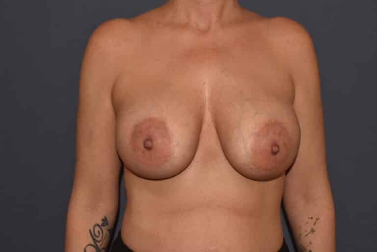 After Image: Breast Augmentation – Ptotic (Sagging) Breasts - front