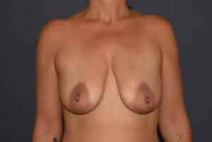 Breast Augmentation – Ptotic (Sagging) Breasts
