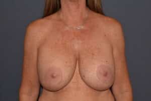 Mastopexy Post Breast Implant Removal