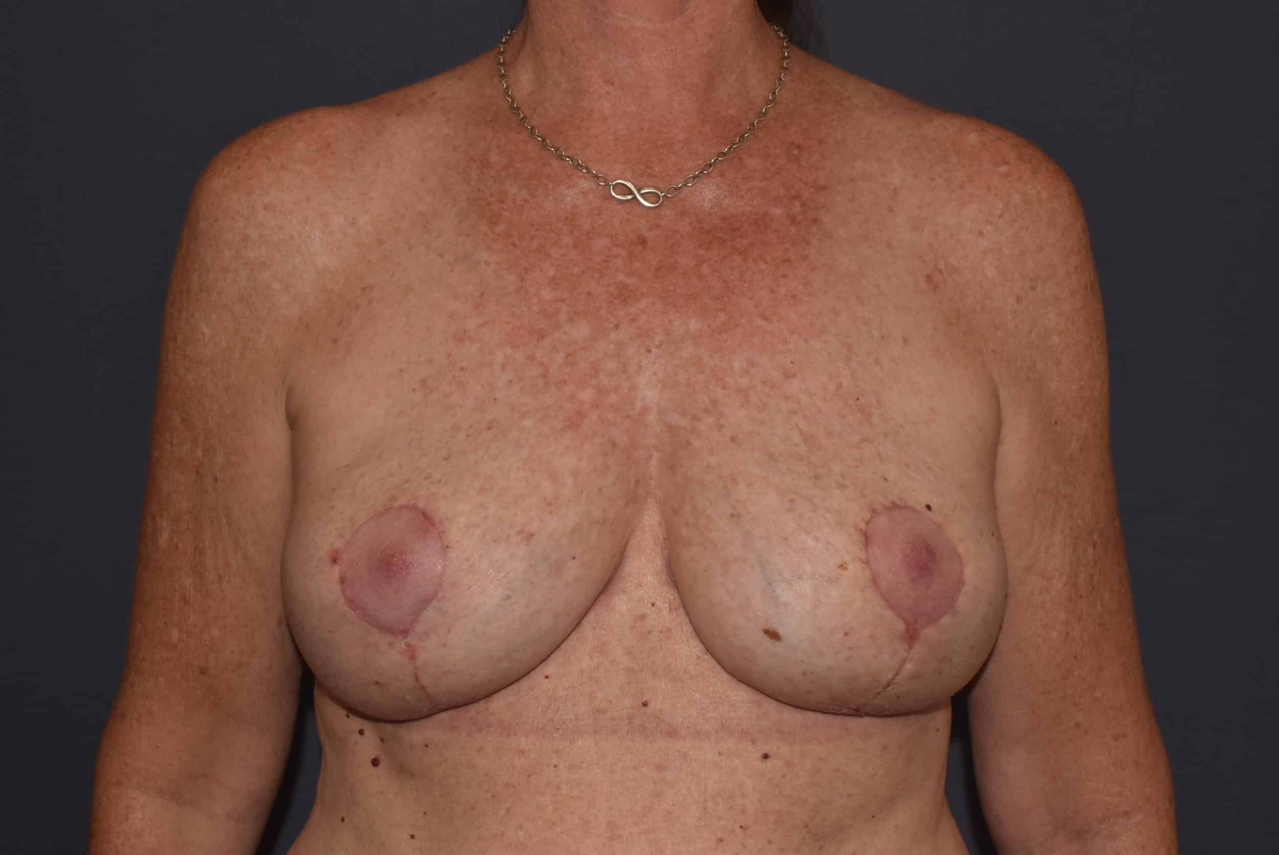 After Image: Mastopexy Post Breast Implant Removal - front