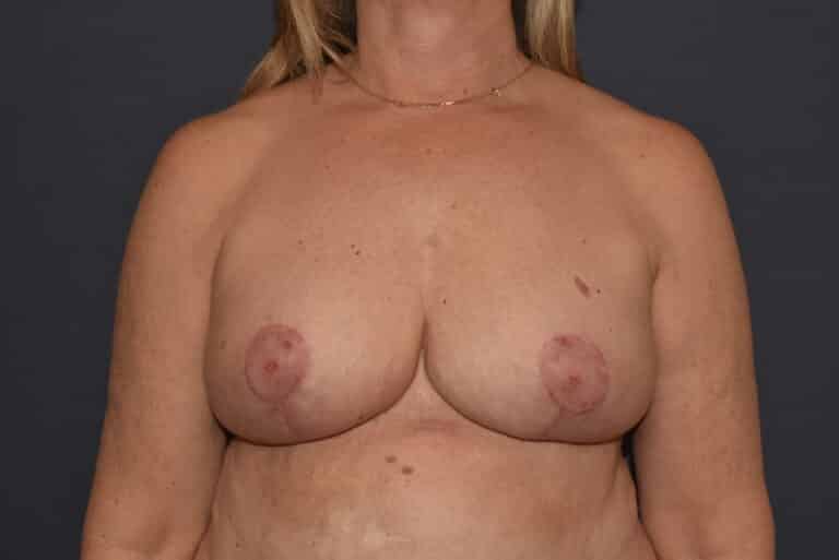 After Image: Mastopexy with Volume Reduction - front