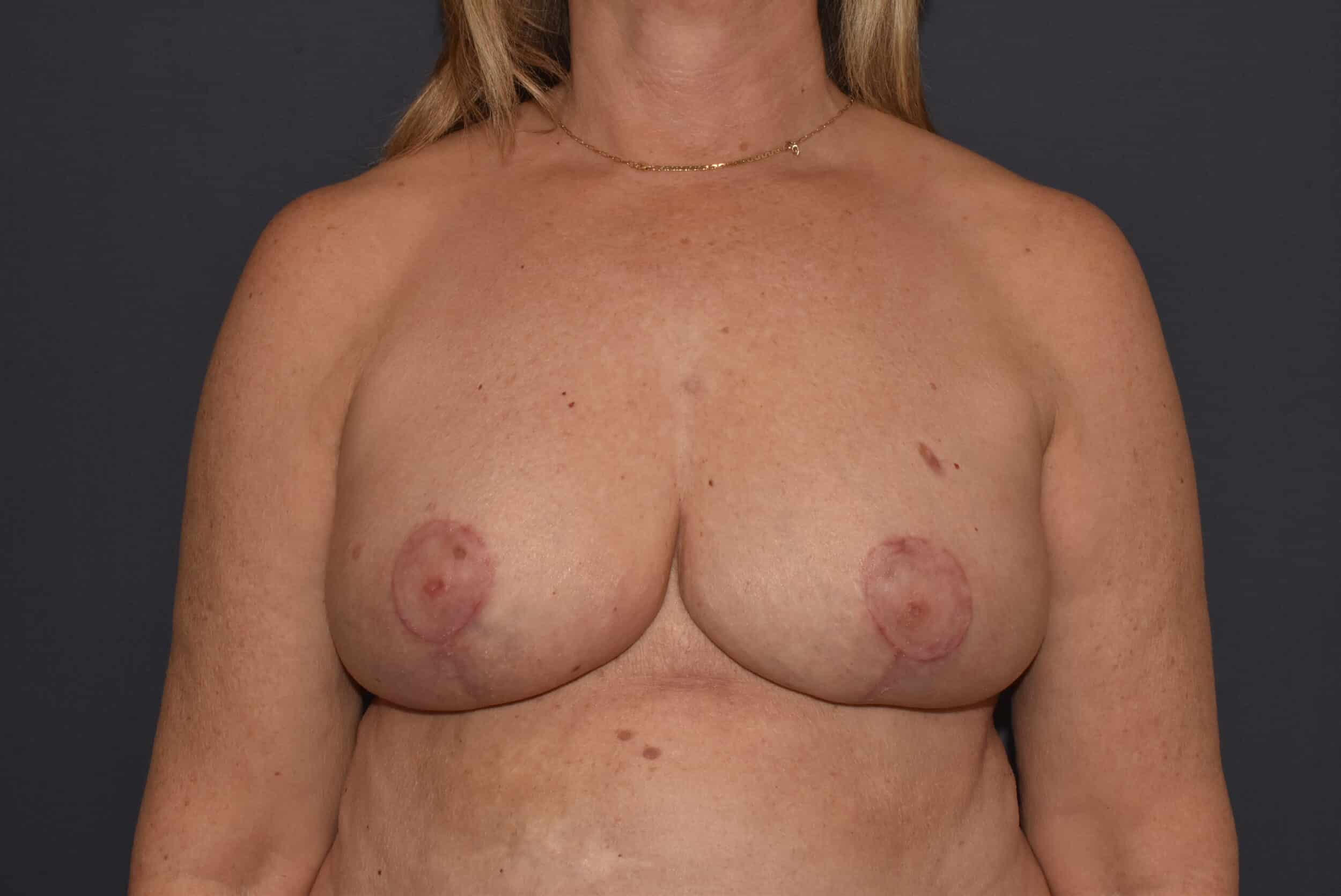 After Image: Mastopexy with Volume Reduction - front