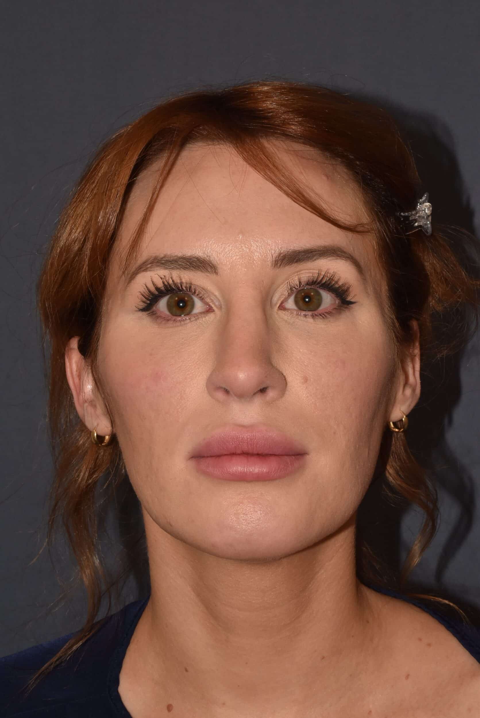 After Image: Rhinoplasty – Open - 
