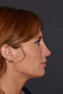 After Image: Rhinoplasty – Open