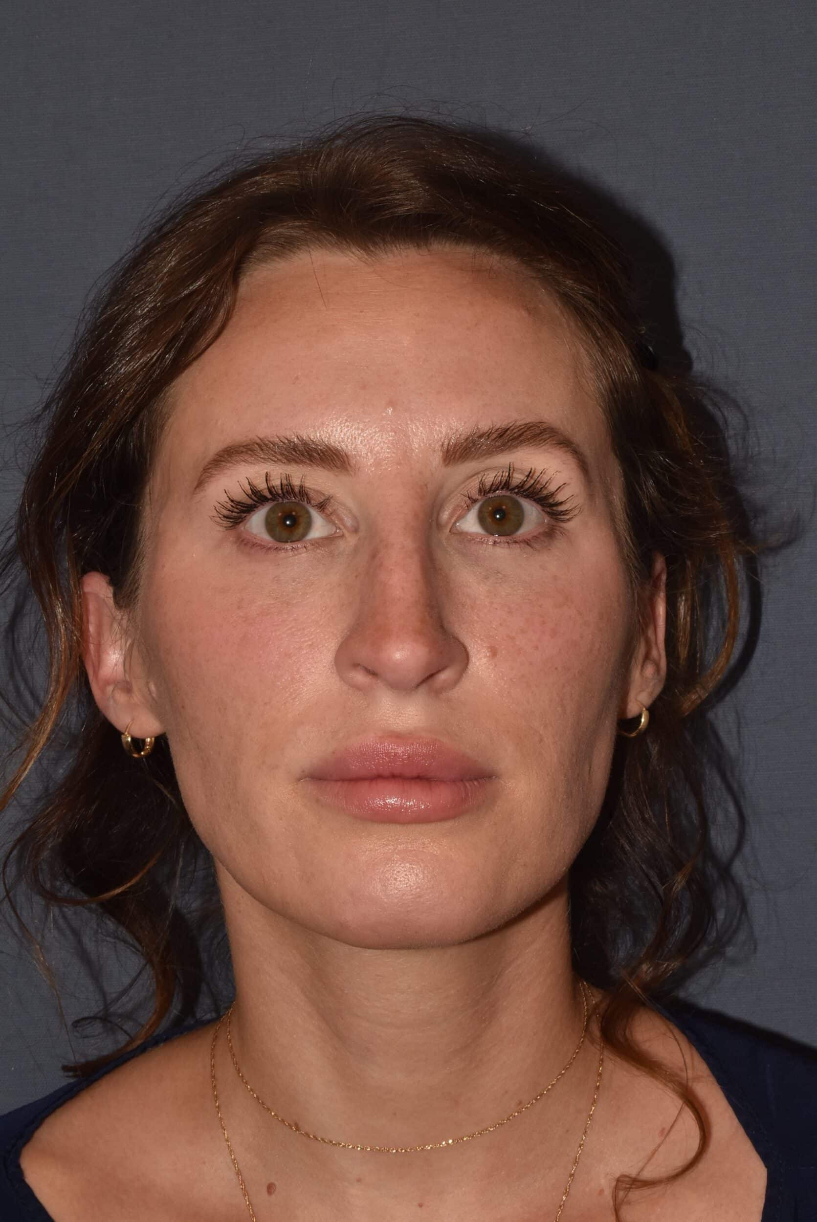 Before Image: Rhinoplasty – Open - 
