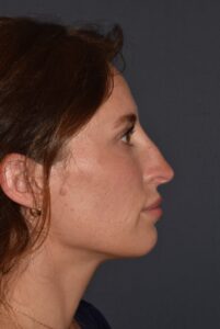 Before Image: Rhinoplasty – Open